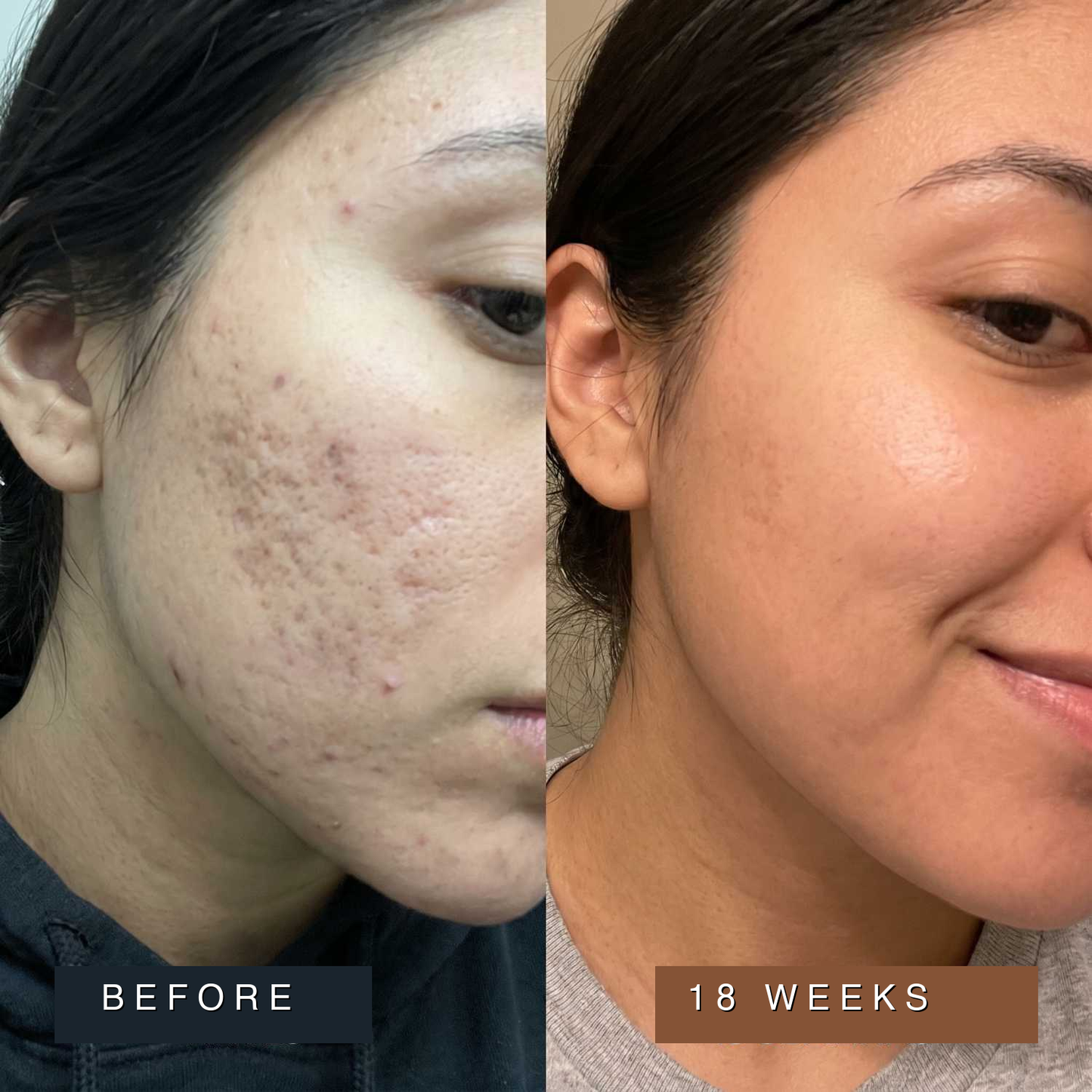 Acne Scar Remodeling Stick